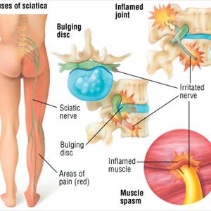 Information Sciatica And Walking - Ischias: Sciatic Nerve Or Sciatica