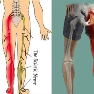 Back Sciatica Images - Top 7 Tips To Treat And Prevent Sciatica