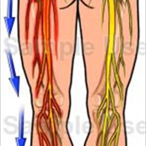 Sciatic Nerve Medication - What Are The 3 Best Exercises For Sciatica?