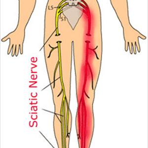 Causes Of Sciatica - Back Pain From Pregnancy, Sciatica, And Lifting