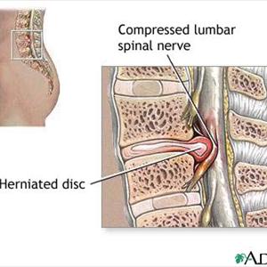 Sciatic Nerve Problems Buttock - Damn, That Pain In My A##! Here