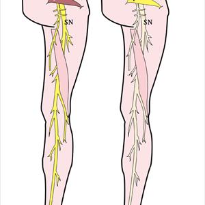 Sciatic Muscle Pain 