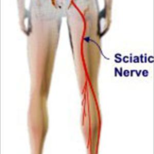 Sleeping With Sciatica - What Are The 3 Best Exercises For Sciatica?