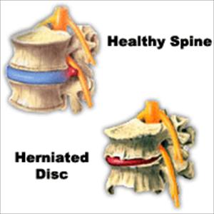 Treatment For Pinched Sciatic Nerve - 3 Questions On Sciatica - Do You Know The "Right" Answers?