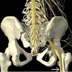Sciatic Nerve Pain Symptoms - Livingston Chiropractic & Rehabilitation Sciatica Report