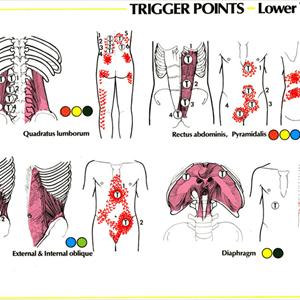 Sciatica Pain Diagram Special Info - Sciatica Exercises That Relieve Back Pain