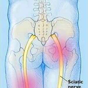 Herbs Sciatica - Sciatic Nerve Pain - What Are The Symptoms And Causes?