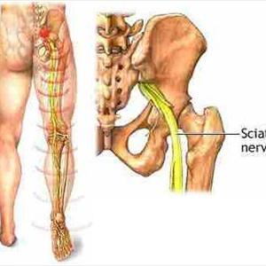  Information On Sciatica And Causes