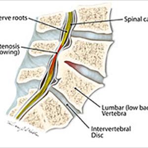 Sciatic Nerve Cushion Support - Proper Sciatica Exercises To Reduce Sciatica Pain
